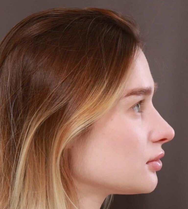 After Image: Septorhinoplasty by: Dr. Thompson - right-side