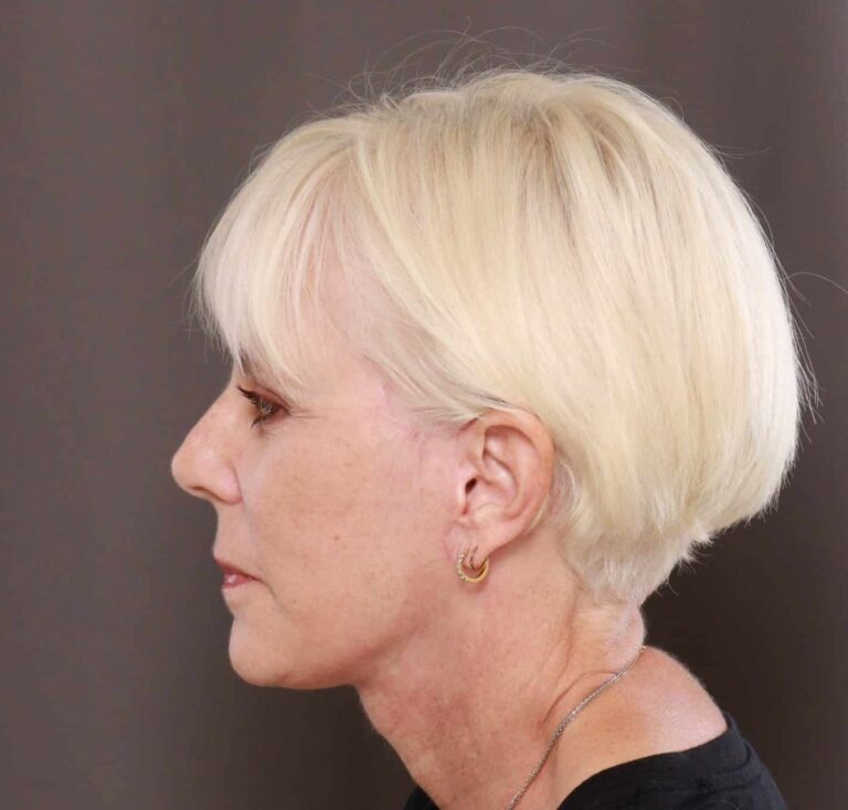 After Image: Facelift by Dr. Henstrom - left-side