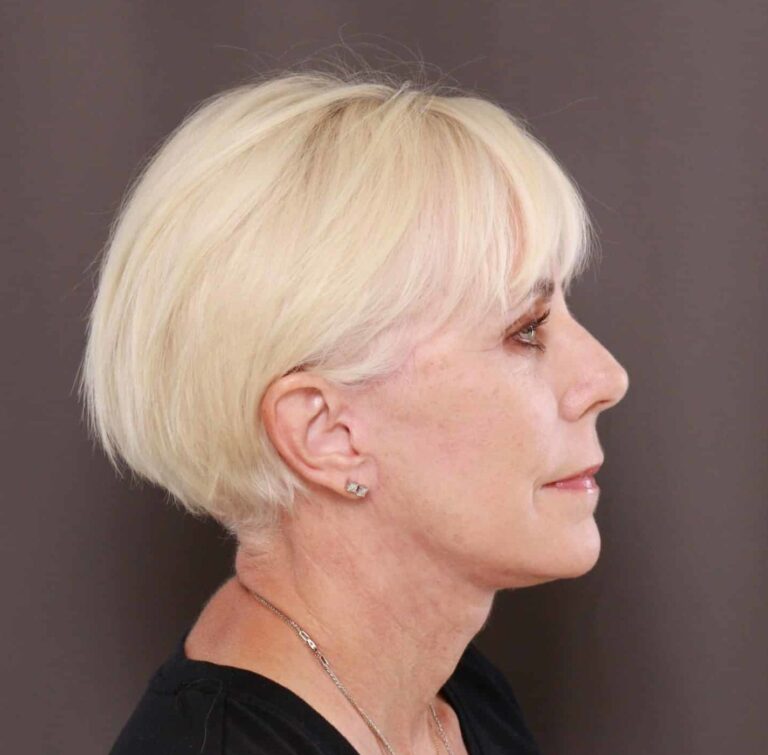 After Image: Facelift by Dr. Henstrom - right-side