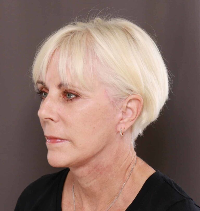 After Image: Facelift by Dr. Henstrom - left-front-oblique