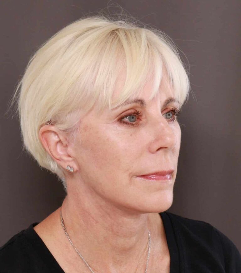 After Image: Facelift by Dr. Henstrom - right-front-oblique