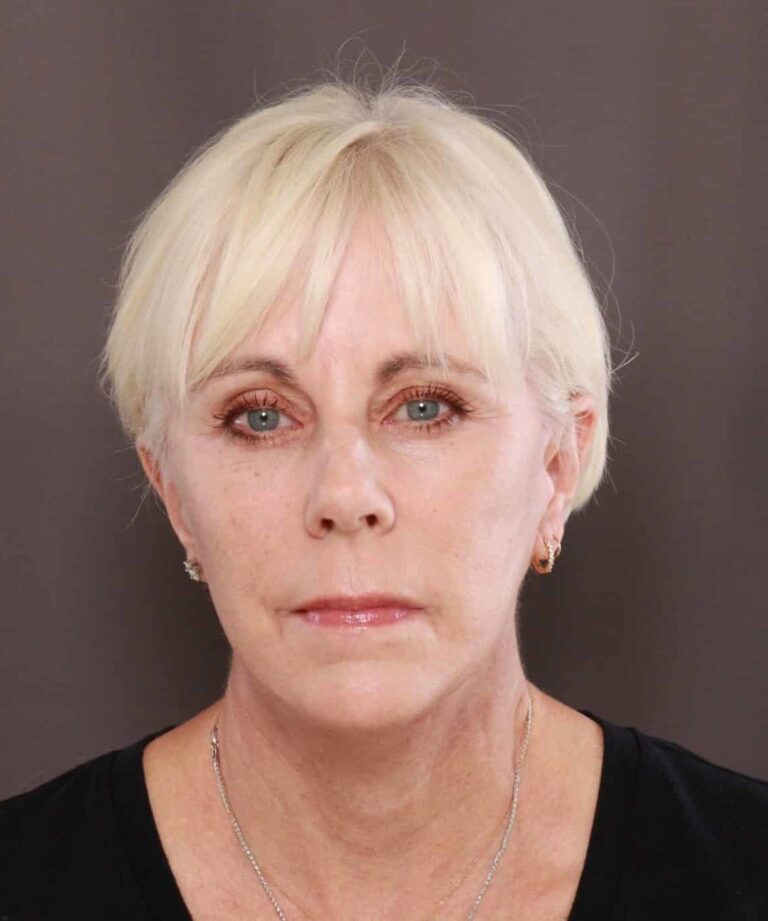 After Image: Facelift by Dr. Henstrom - front