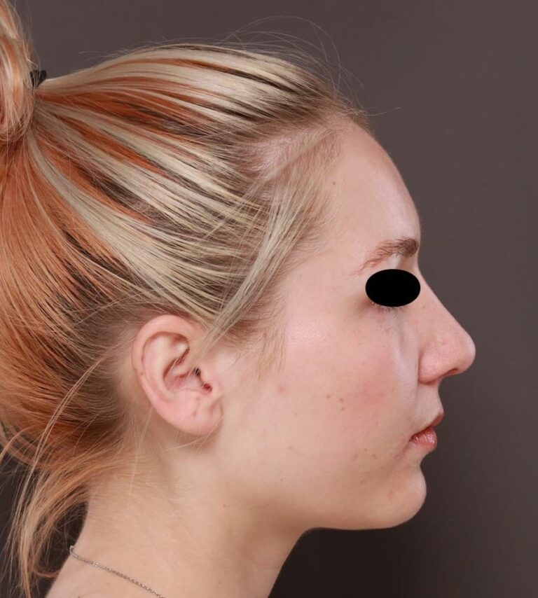 After Image: Rhinoplasty by: Dr. Henstrom - right-side