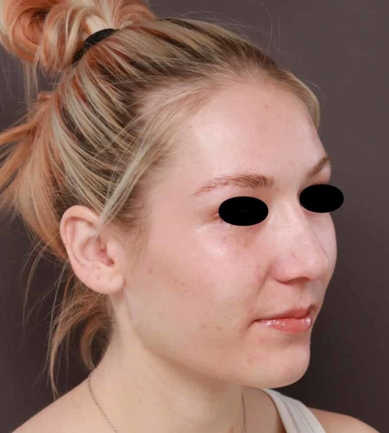 After Image: Rhinoplasty by: Dr. Henstrom - right-front-oblique