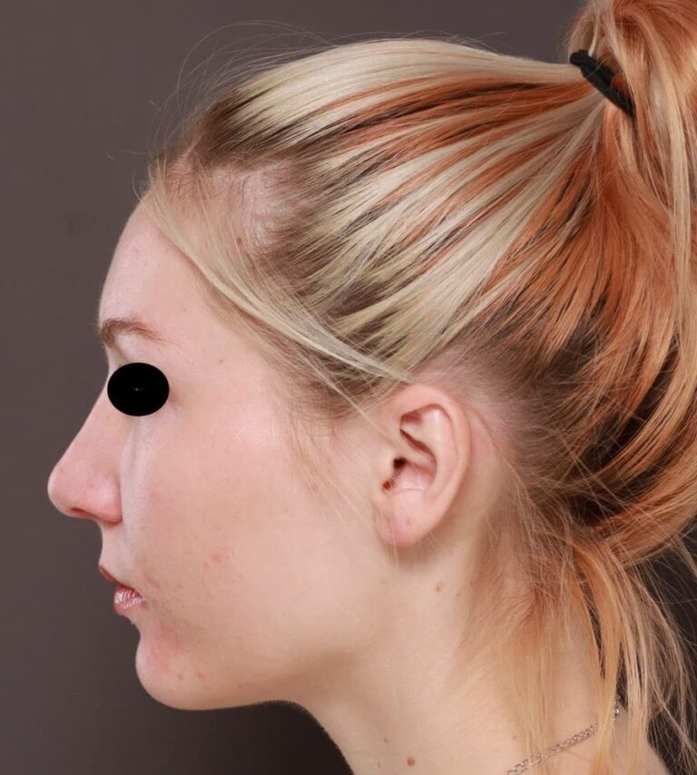 After Image: Rhinoplasty by: Dr. Henstrom - left-side