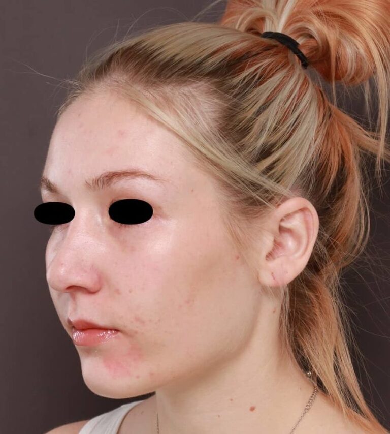 After Image: Rhinoplasty by: Dr. Henstrom - left-front-oblique