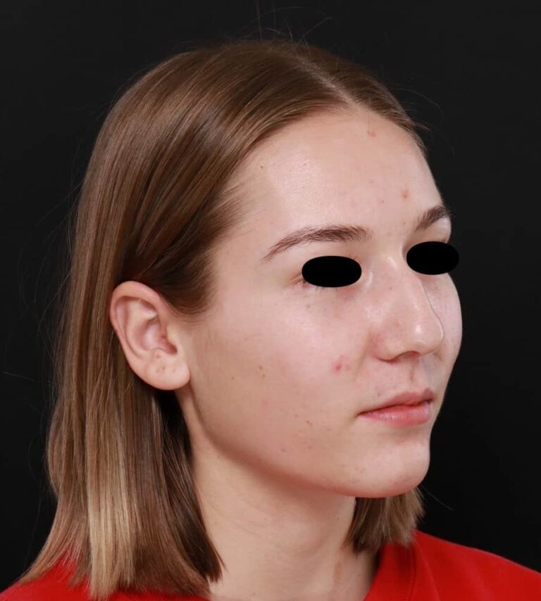 Before Image: Rhinoplasty by: Dr. Henstrom - right-front-oblique