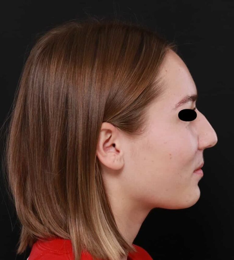 Before Image: Rhinoplasty by: Dr. Henstrom - right-side