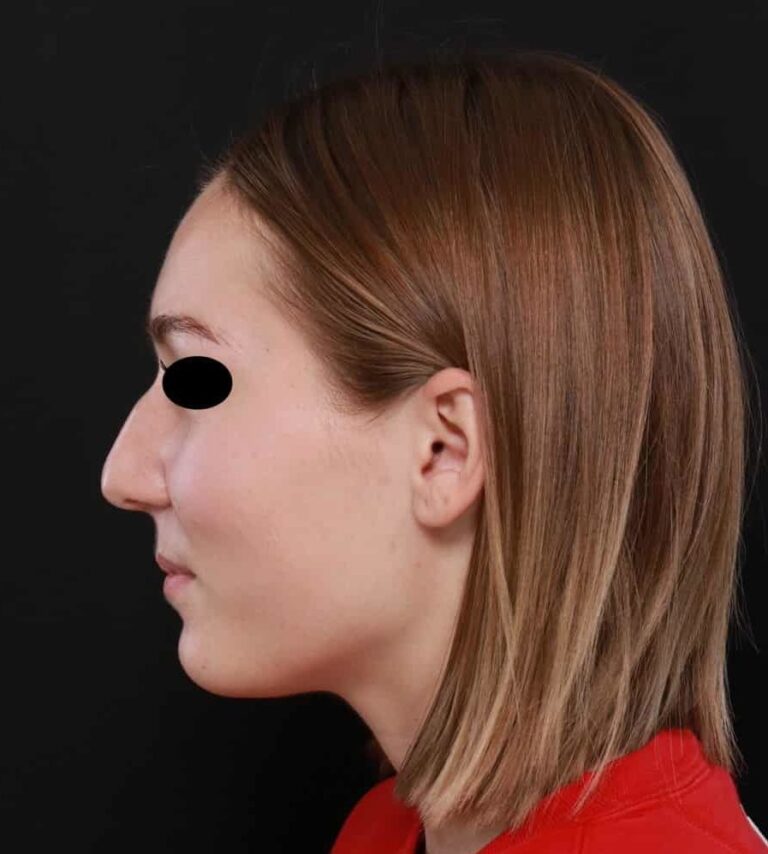 Before Image: Rhinoplasty by: Dr. Henstrom - left-side