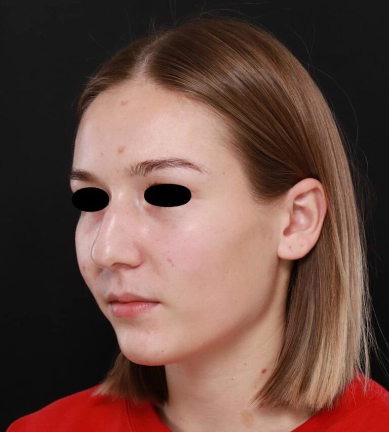 Before Image: Rhinoplasty by: Dr. Henstrom - left-front-oblique