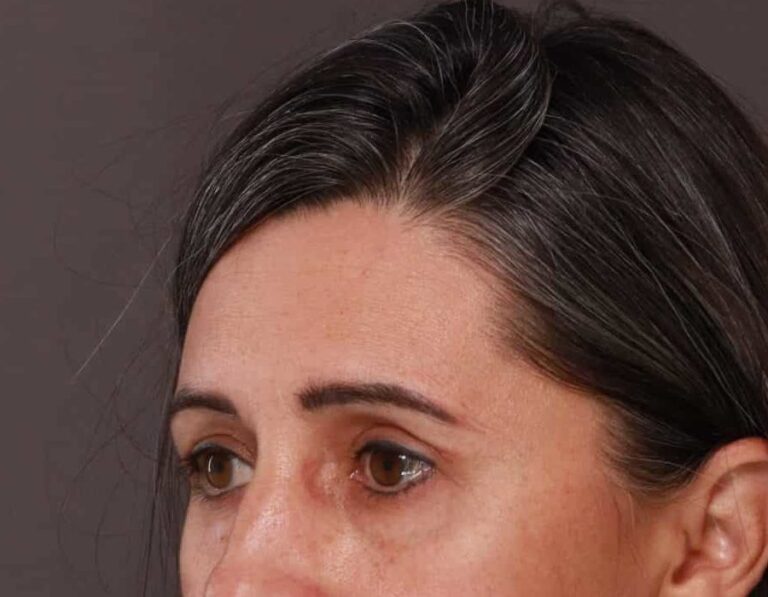 After Image: Upper Eyelid Lift by: Dr. Thompson - left-front-oblique