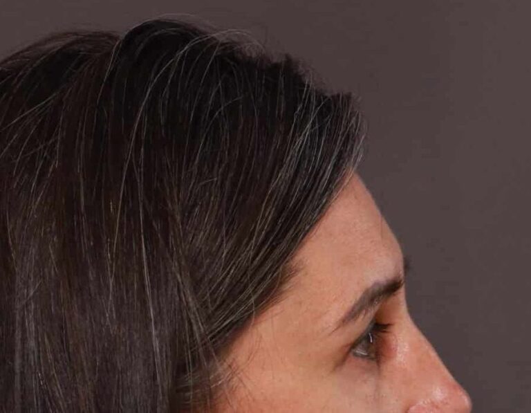 After Image: Upper Eyelid Lift by: Dr. Thompson - right-side