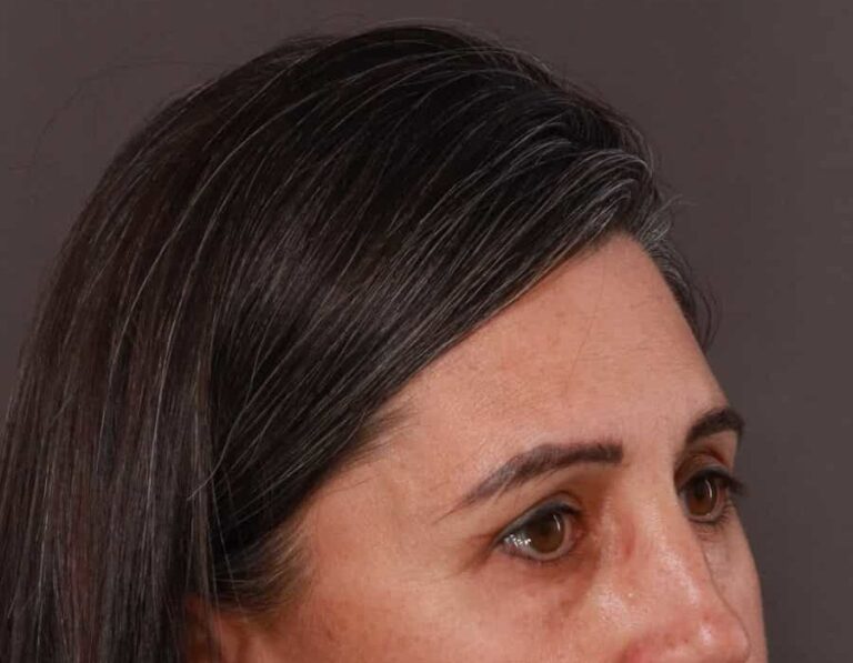 After Image: Upper Eyelid Lift by: Dr. Thompson - right-front-oblique