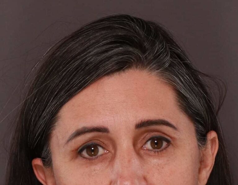 After Image: Upper Eyelid Lift by: Dr. Thompson - front