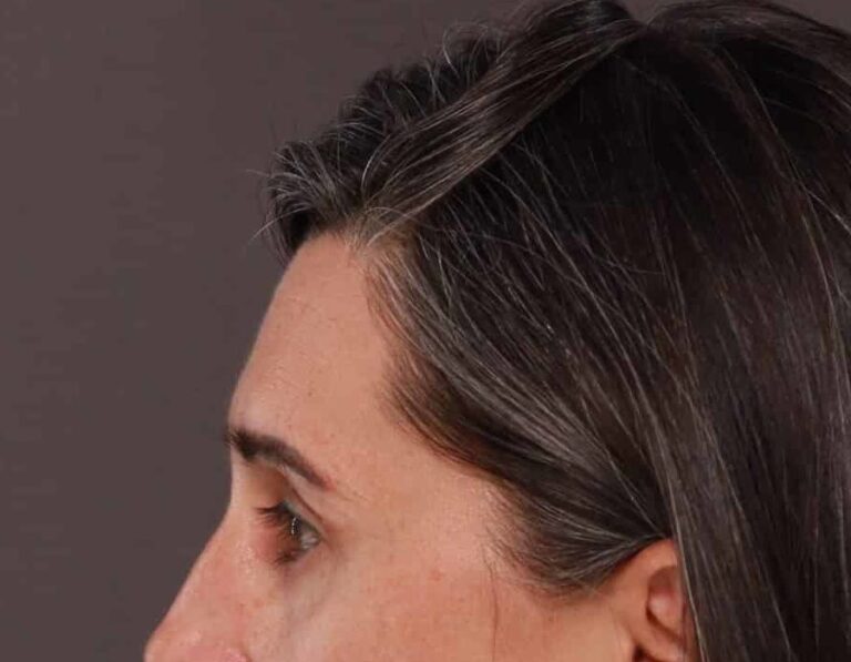 After Image: Upper Eyelid Lift by: Dr. Thompson - left-side