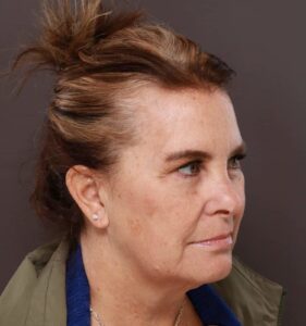 Before Image: Facelift and VI Peel by: Dr. Thompson