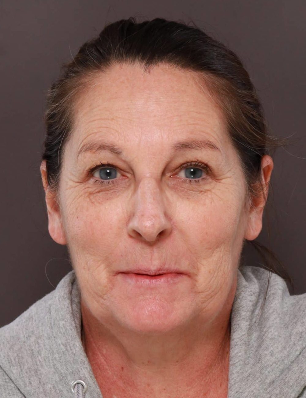 Gallery Cases Archive Page 94 of 96 Utah Facial Plastics