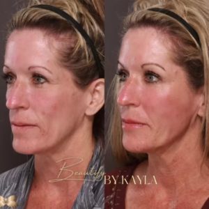 Rellenos dérmicos de Botox y Sculptra