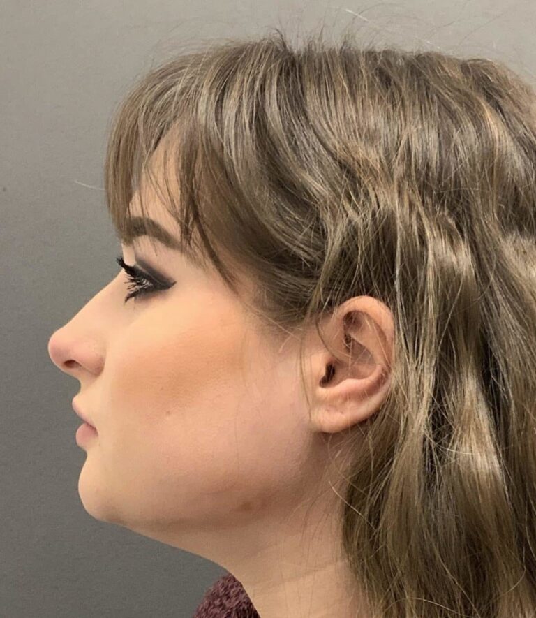 Before Image: Septorhinoplasty by: Dr. Thompson - left-side