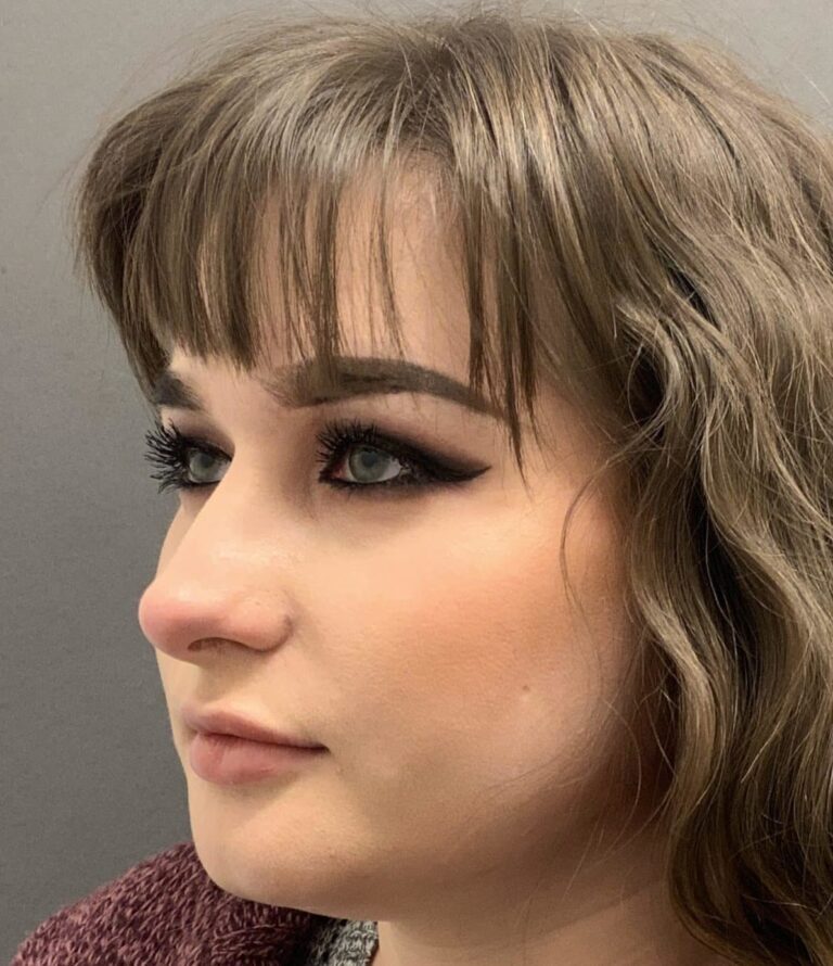 Before Image: Septorhinoplasty by: Dr. Thompson - left-front-oblique