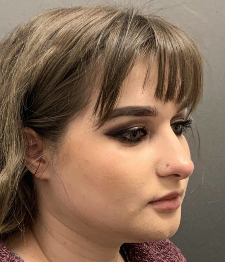 Before Image: Septorhinoplasty by: Dr. Thompson - right-front-oblique