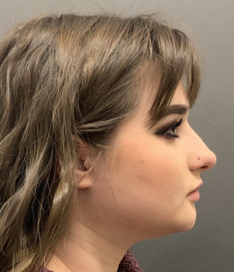 Before Image: Septorhinoplasty by: Dr. Thompson - right-side