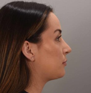 Deep Neck Contouring by: Dr. Manning
