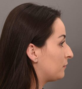 Deep Neck Contouring by: Dr. Manning