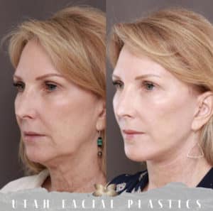 Facelift Results