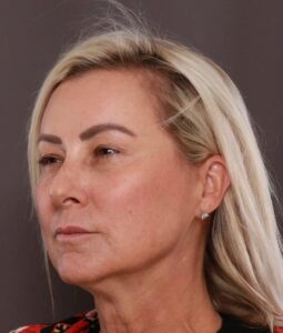 Halo Laser Resurfacing by: Katy