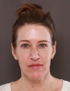 Chemical Peel by: UFP Aesthetican
