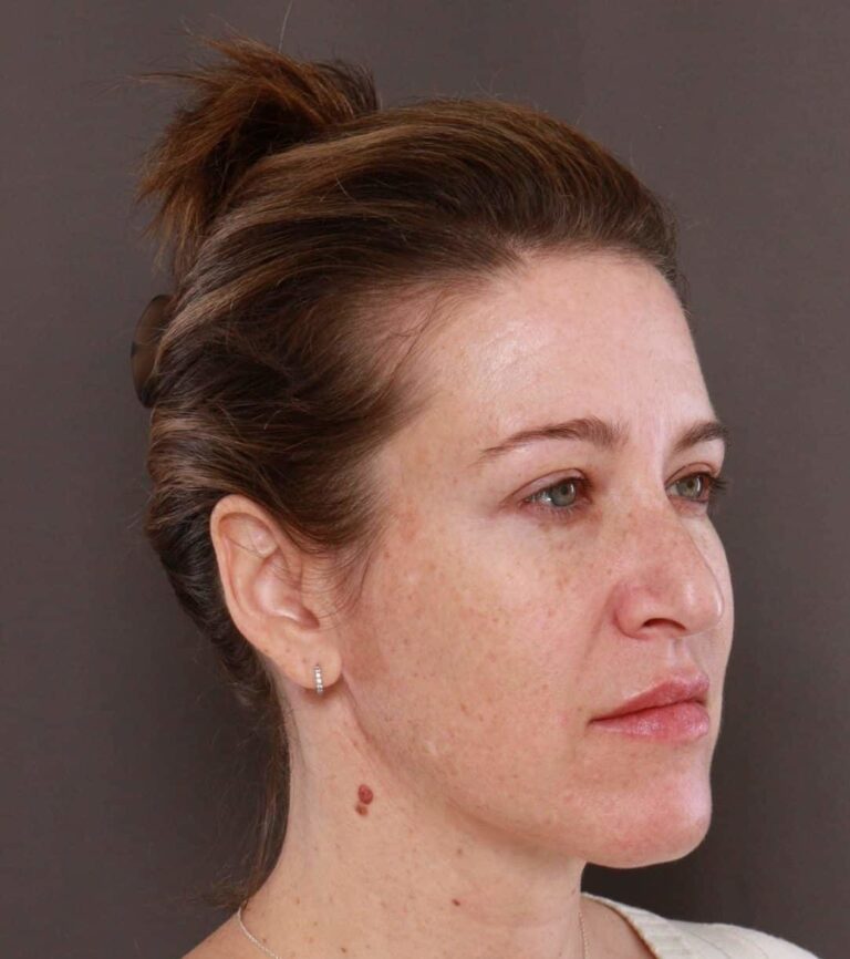 After Image: Chemical Peel by: UFP Aesthetican - right-front-oblique