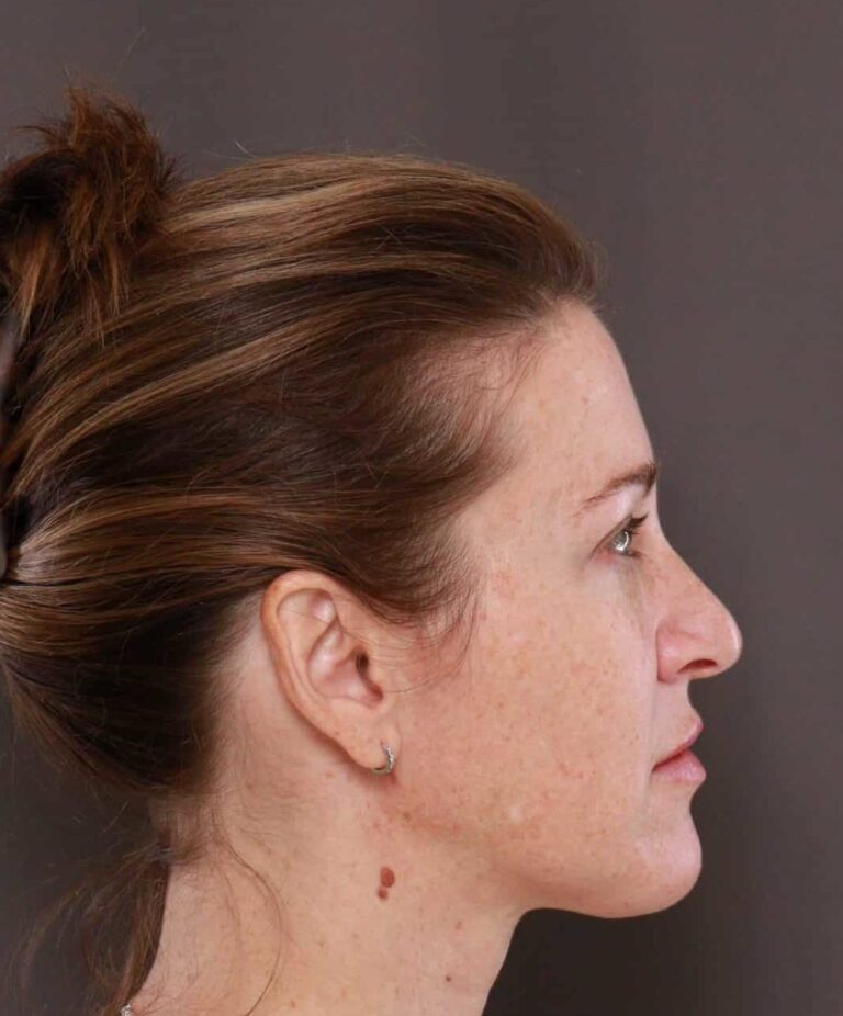 After Image: Chemical Peel by: UFP Aesthetican - right-side