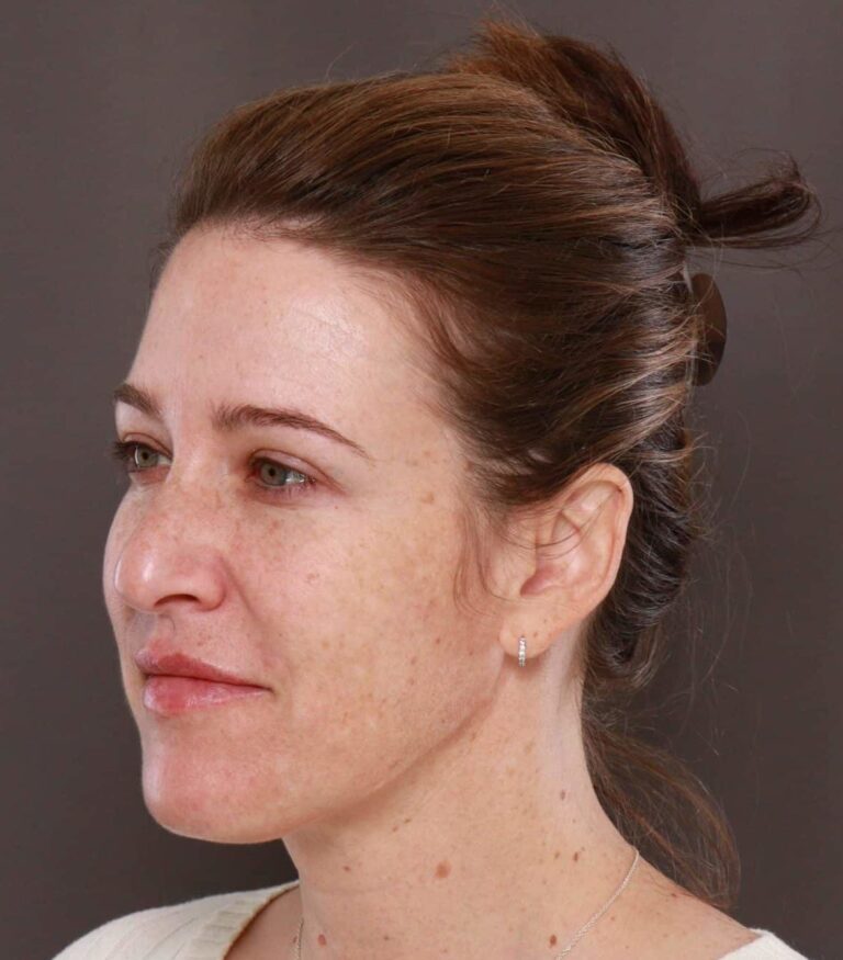 After Image: Chemical Peel by: UFP Aesthetican - left-front-oblique