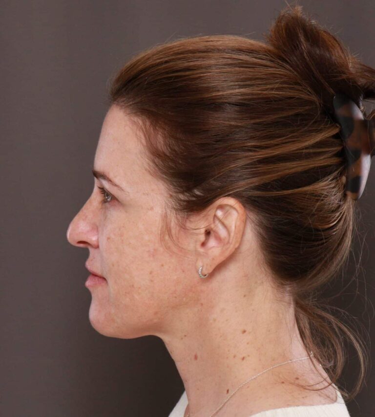 After Image: Chemical Peel by: UFP Aesthetican - left-side
