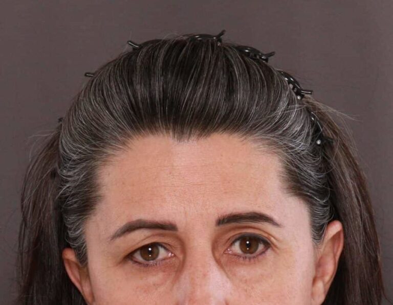 Before Image: Upper Eyelid Lift by: Dr. Thompson - front