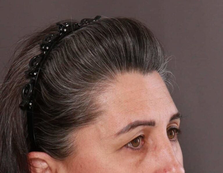 Before Image: Upper Eyelid Lift by: Dr. Thompson - right-front-oblique