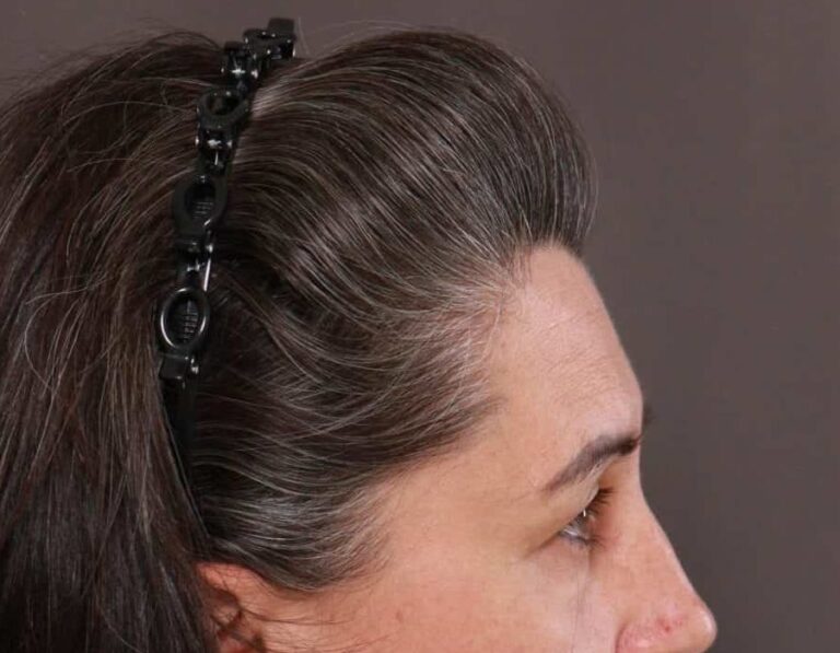 Before Image: Upper Eyelid Lift by: Dr. Thompson - right-side