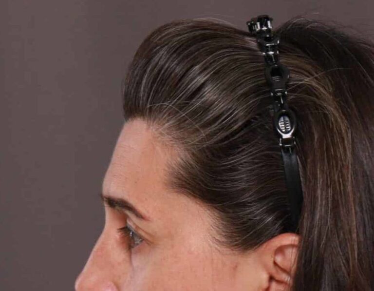 Before Image: Upper Eyelid Lift by: Dr. Thompson - left-side