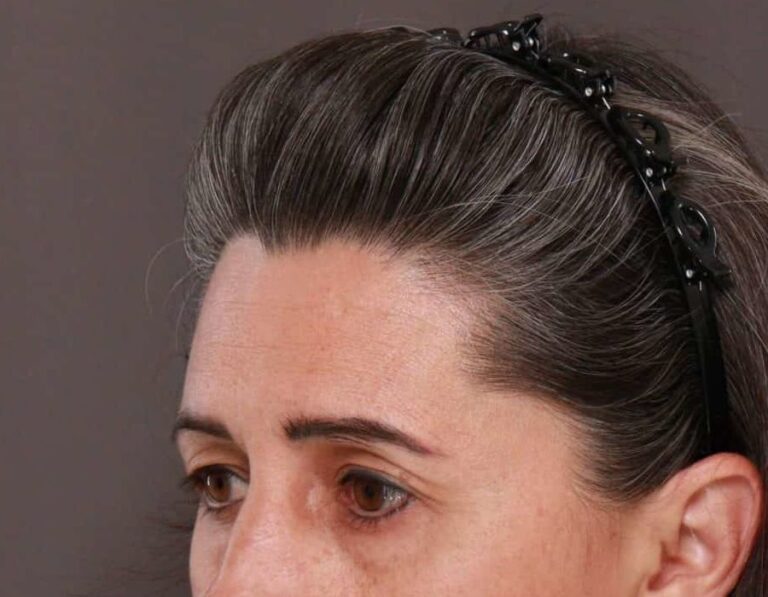 Before Image: Upper Eyelid Lift by: Dr. Thompson - left-front-oblique