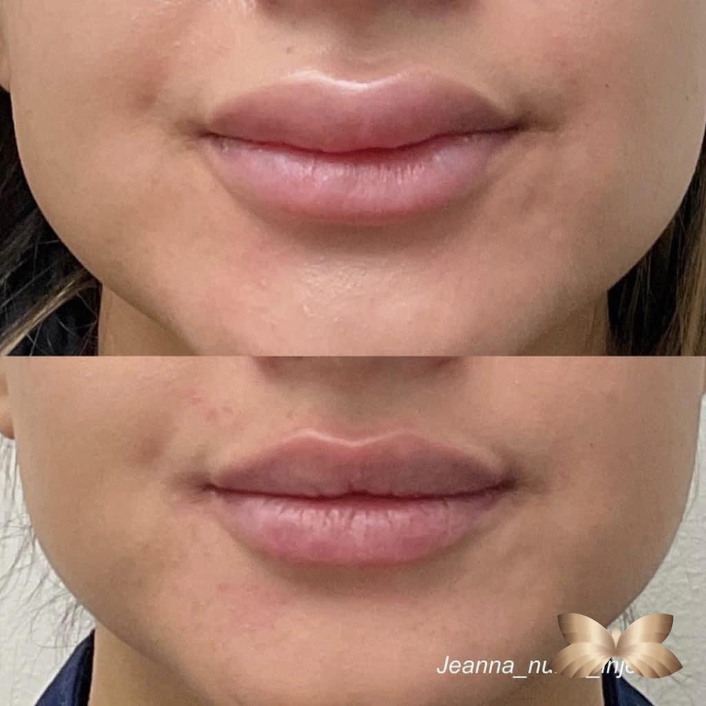 Lip Filler Correction by UFP Injector Jeanna Wilkerson