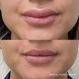 Lip Filler Correction by UFP Injector Jeanna Wilkerson