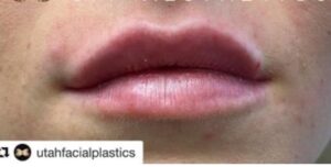 Lip Augmentation By: UFP Nurse Injector