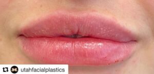 Lip Augmentation by: UFP Nurse Injector
