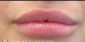 Lip Augmentation by: UFP Nurse Injector