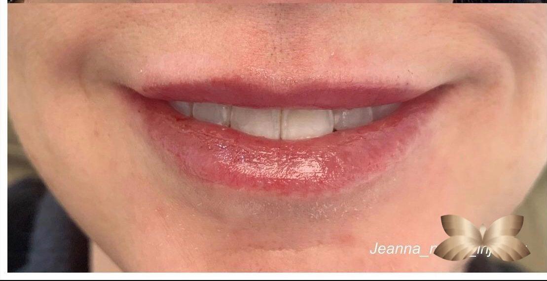 Lip Augmentation By: Nurse Injector Jeanna