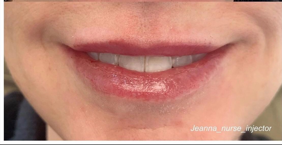 Lip Augmentation by Nurse Injector Utah Facial Plastics