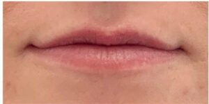 Before Image: Lip Augmentation By: Jeanna