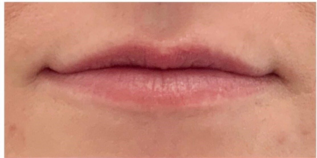 Lip Augmentation by Jeanna Utah Facial Plastics