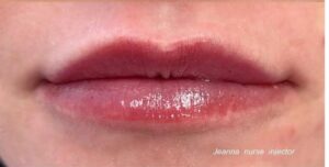 After Image: Lip Augmentation By: Jeanna